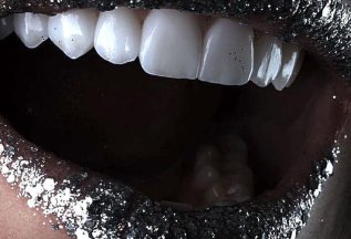 Кислородное отбеливание зубов AMAZING WHITE - 15000₽