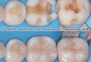 Лечение зубов по старым ценам до 1.08.2025г