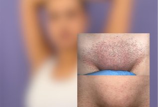 500 бонусов на лазерную эпиляцию
