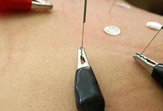 Обучение иглоукалывани, электропунктура, аурикулотерапия