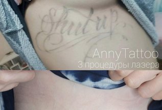 Удаление татуировок в Тату-салоне AnnyTattoo studio от 1500р