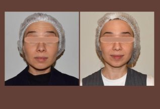 Ботулинотерапия Full Face – это не про «заморозку» 💉