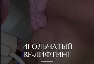 Игольчатый RF-лифтинг
