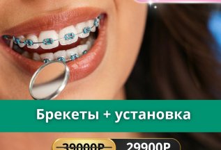 Брекеты+ установка 29900руб🎁