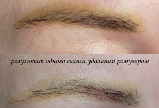 Борьба с желтым цветом татуажа