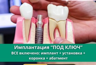 Имплантация «ПОД КЛЮЧ»
