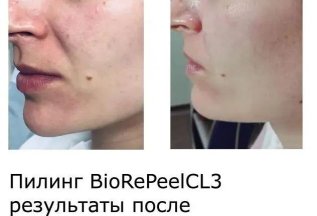 Преимущества BioRePeelCl3