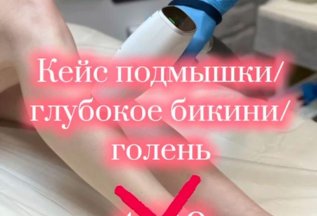 Лазерная эпиляция