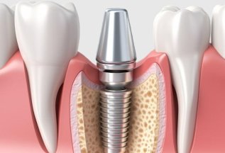 Имплант Dentium + установка
