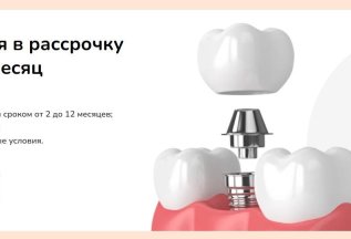 Имплантация в рассрочку от 1670р в месяц