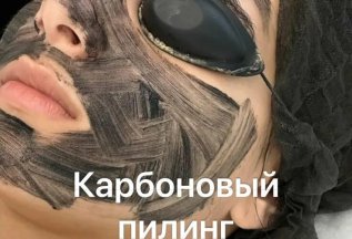 Карбоновый пилинг лица – 5 сеансов по выгодной цене!
