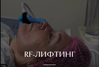 RF-лифтинг лица