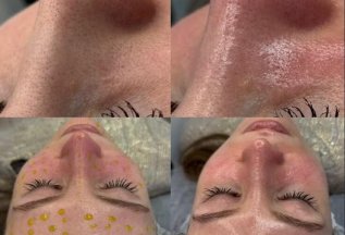 Hydrafacial + пилинг