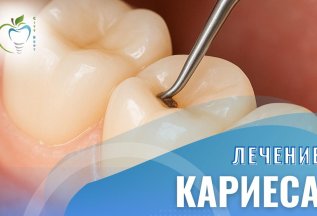 Лечение кариеса
