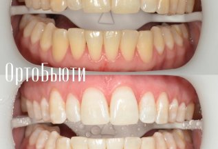 Отбеливание зубов: путь к сияющей улыбке!
