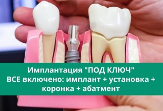 Имплантация «ПОД КЛЮЧ»