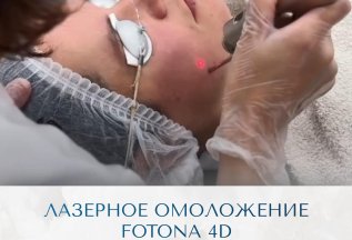 ЛАЗЕРНОЕ ОМОЛОЖЕНИЕ FOTONA 4D