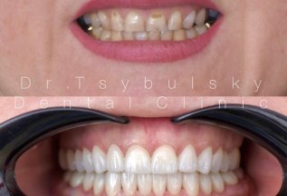 15% скидка на Виниры Emax