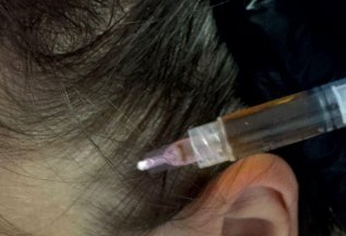 Консультация дерматовенеролога трихолога бесплатно