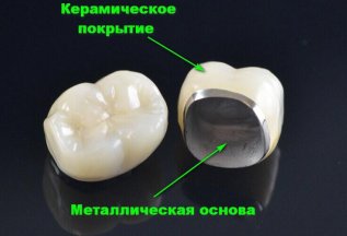 ✅МИНУС 10% на металлокерамические коронки 🦷