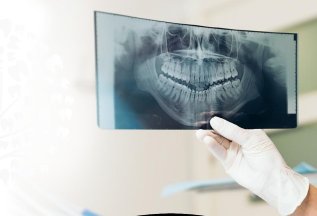 Имплантация ПОД ключ с циркониевой коронкой