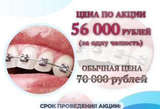 Установка безлигатурных брекетов со скидкой