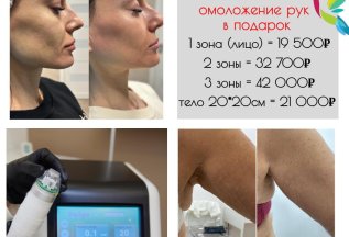 Микроигольчатый радиоволновой лифтинг! АКЦИЯ!!!
