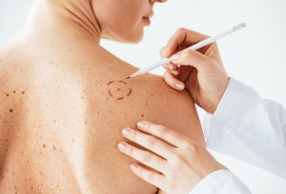-50% на консультацию врача перед удалением новообразований