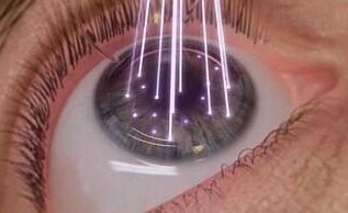 Лазерная коррекция зрения методом superLASIK и transPRK