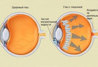 Лечение глаукомы