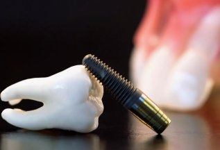 Бесплатная консультация всех специалистов при имлантации