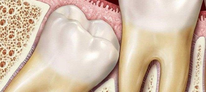 Удаление ретенированного зуба любой сложности