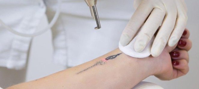 Удаление татуировки - 2-я процедура бесплатно! RedClinic
