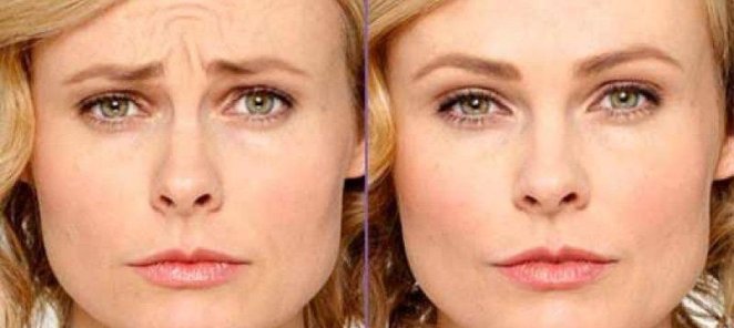 💉 Морщины? Забудь надолго — Botox от 290 ₽ за ед.!