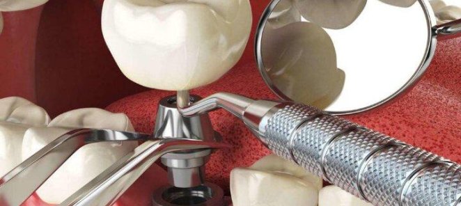 Имплантация - Dentium