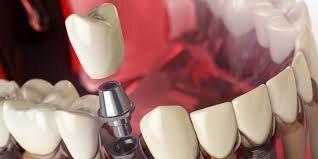 ЛУЧШИЙ ИМПЛАНТ В МИРЕ Straumann Roxolid под ключ за 55000