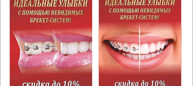 брекеты