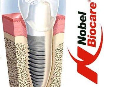 Установка имплантата Nobel Biocare за 50000 рублей