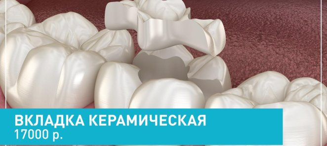 Вкладки керамические 17000 рублей