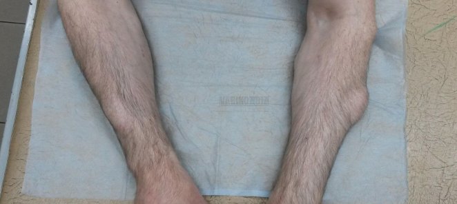При удалении нескольких липом (жировиков) скидка до 50%