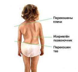 Лечение детей: сколиозы, плоскостопие, вальгус, после травм