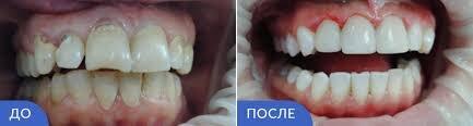 Акция. Восстановление зуба 8000 руб