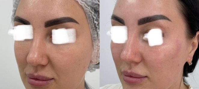 Full-Face омоложение и коррекция лица со скидкой 25%