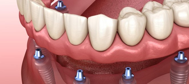 Зубы за 1 день по методике все на 4-6 зубах