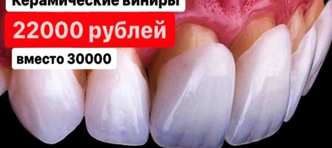 Керамические виниры 22000 рублей