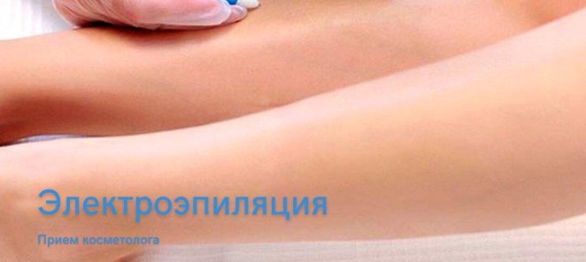 Эпиляция