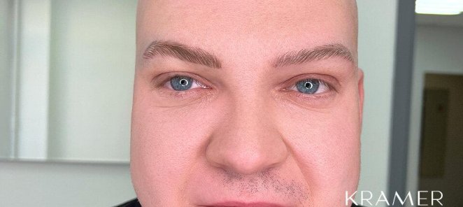 Бесплатный татуаж при алопеции