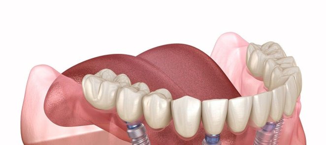 All-on-4/6 - протезирование зубов 