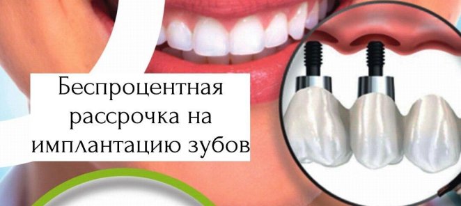 Беспроцентная рассрочка на имплантацию зубов