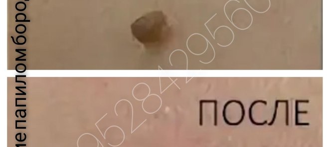 Удаление папилом бородавок родинок